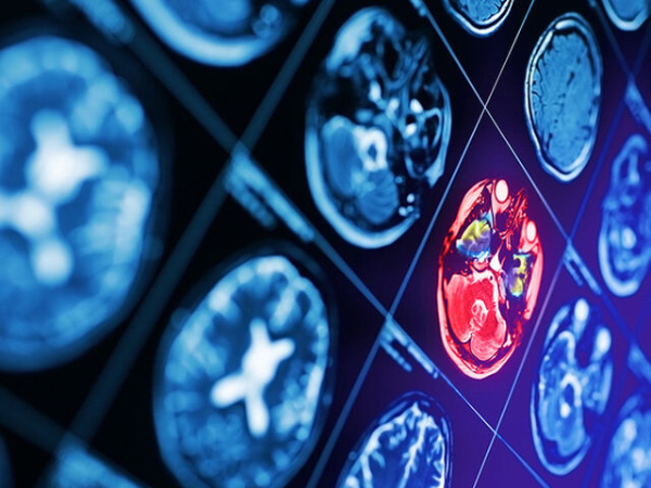 未破裂脳動脈瘤の経過観察と専門治療